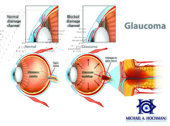 Dr. Michael A. Hochman Takes a Closer Look at Glaucoma